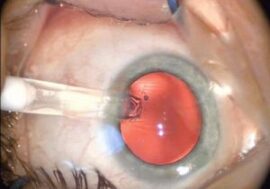 Close Up of Visian ICL Surgery